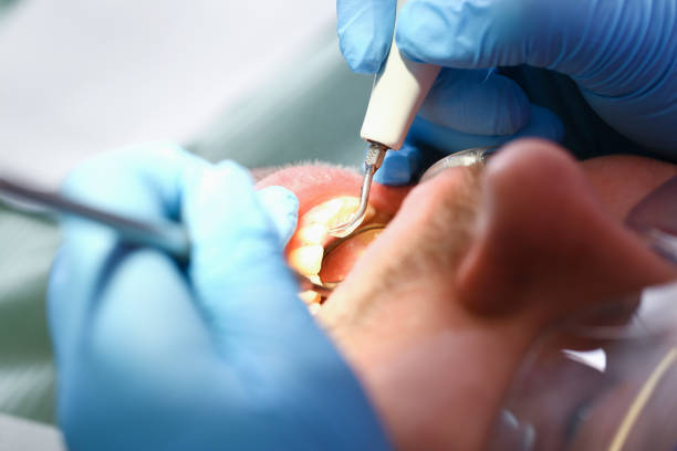 Best Emergency Root Canal Treatment in South Creek, WA